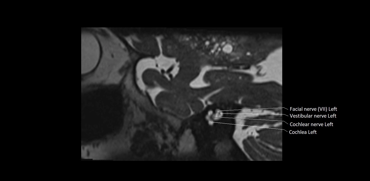 Cranial nerve sagittal anatomy MRI 3T image 9.webp